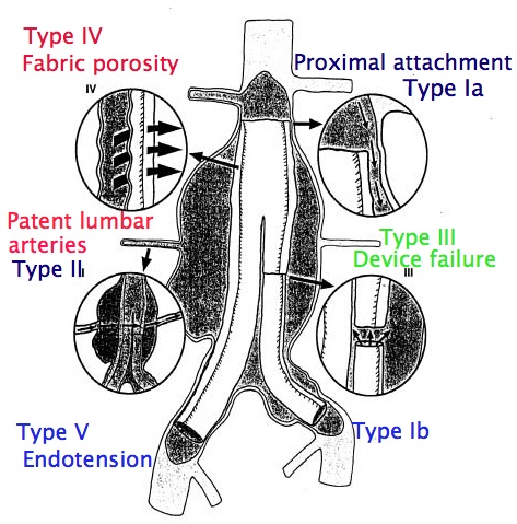 Endoleaks classification